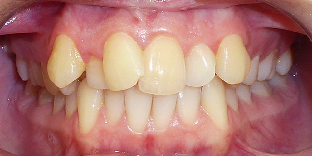 Исправление прикуса зубов с помощью брекетов Damon Clear - фото №1