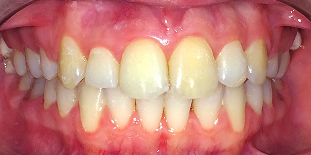 Исправление прикуса зубов с помощью брекетов Damon Clear - фото №2