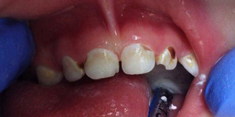 Лечение кариеса и восстановление разрушенных молочных зубов - фото №1