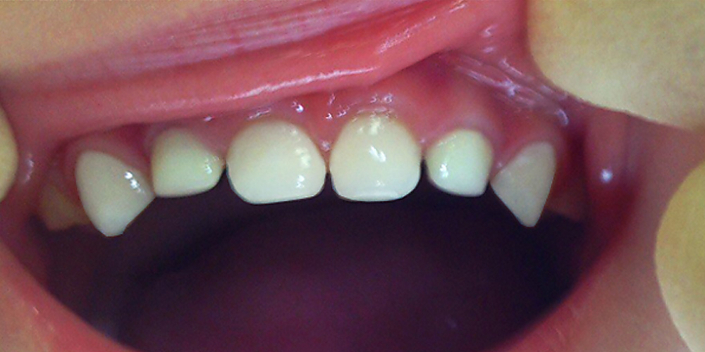 Лечение кариеса и восстановление разрушенных молочных зубов - фото №2