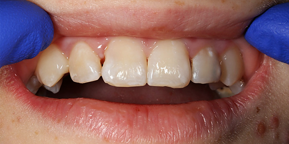 Лечение кариеса и реставрация передних зубов пломбировочным материалом - фото №1