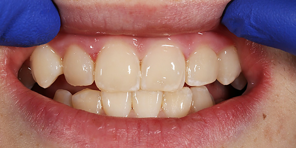 Лечение кариеса и реставрация передних зубов пломбировочным материалом - фото №2