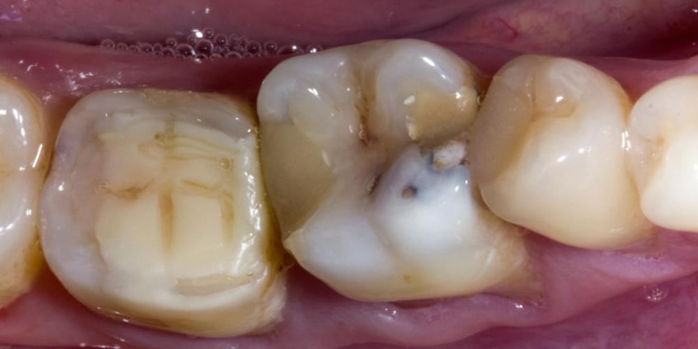 Обострение хронического фиброзного пульпита зуба 3.6 - фото №1