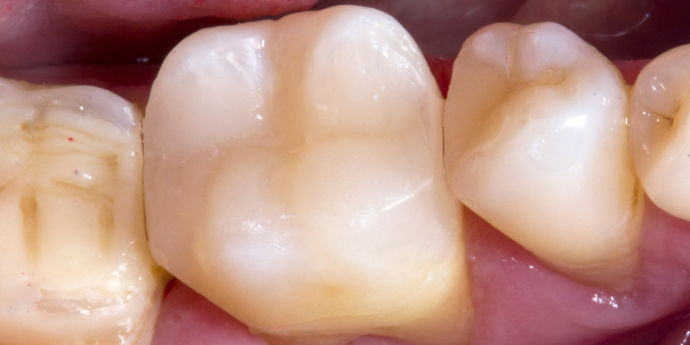 Обострение хронического фиброзного пульпита зуба 3.6 - фото №2