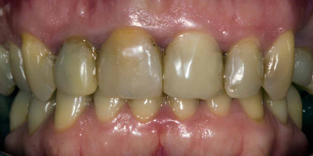 Результат прямой композитной реставрации зубов материалом Filtek Ultimate - фото №1