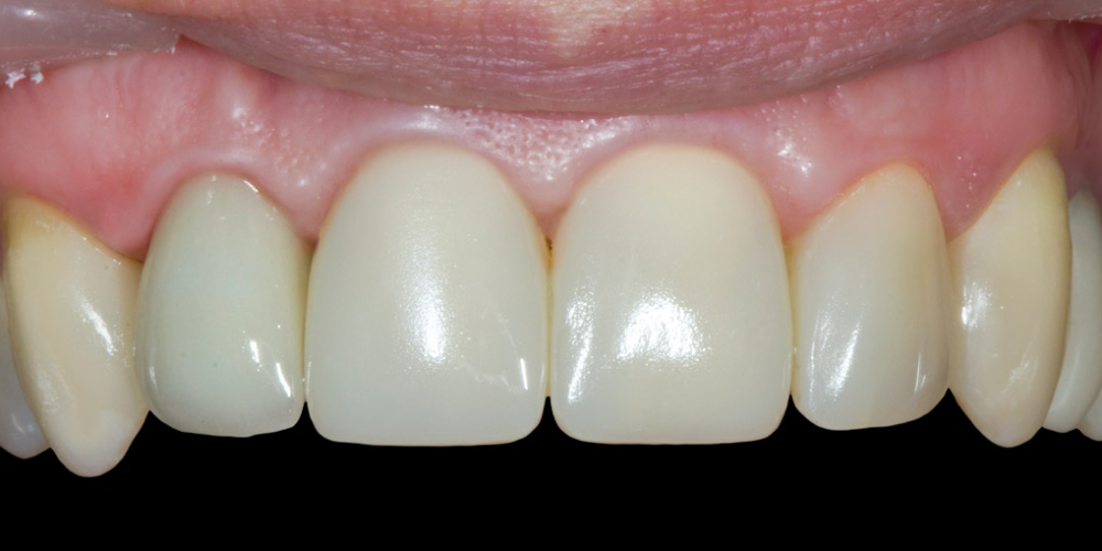 Результат прямой композитной реставрации зубов материалом Filtek Ultimate - фото №4