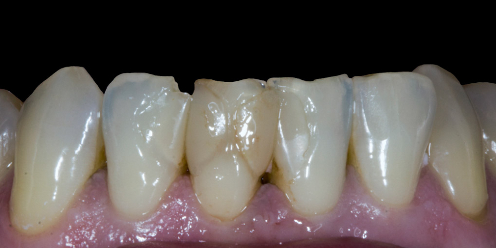 Результат прямой композитной реставрации зубов материалом Filtek Ultimate - фото №3