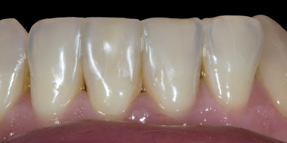 Результат прямой композитной реставрации зубов материалом Filtek Ultimate - фото №2