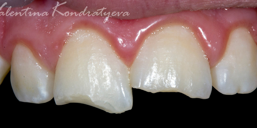 Реставрация дефекта передних зубов прямым способом - фото №1