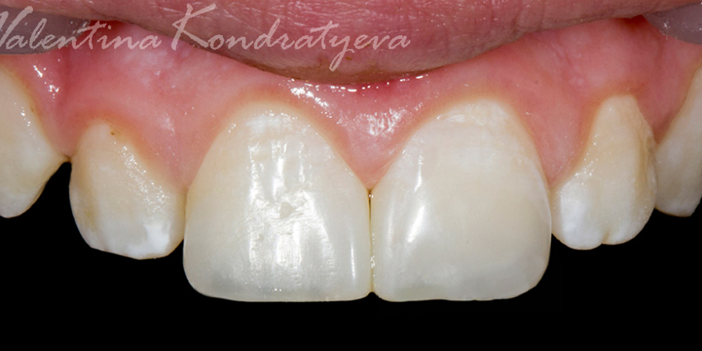 Реставрация дефекта передних зубов прямым способом - фото №2