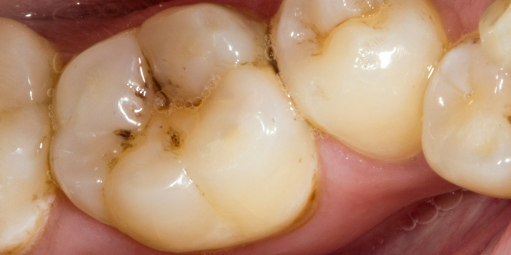 Результат реставрации жевательного зуба Filtek Ultimate - фото №1