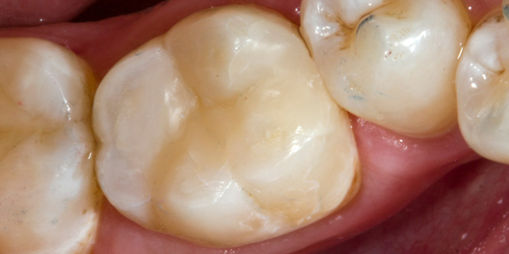 Результат реставрации жевательного зуба Filtek Ultimate - фото №2