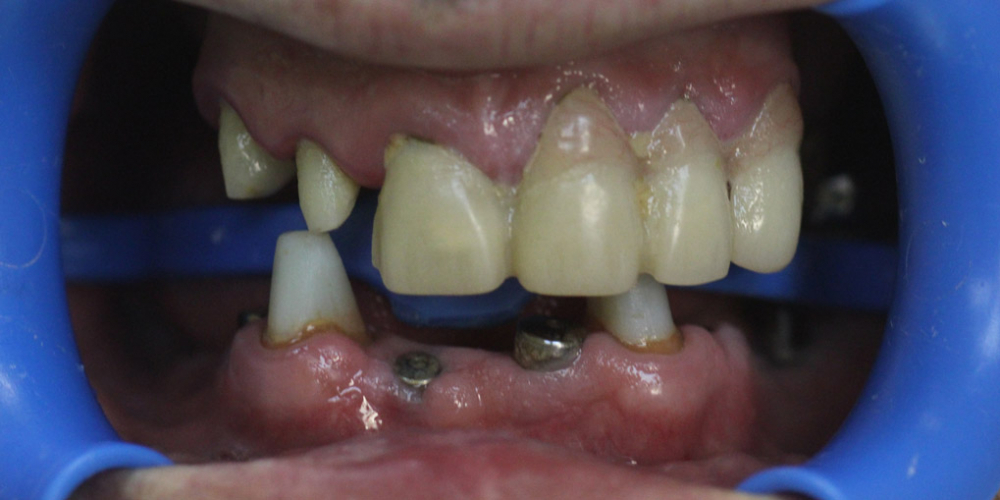Полная эстетико-функциональная реабилитация зубов - фото №1