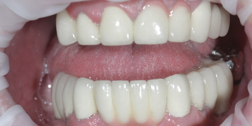 Полная эстетико-функциональная реабилитация зубов - фото №3
