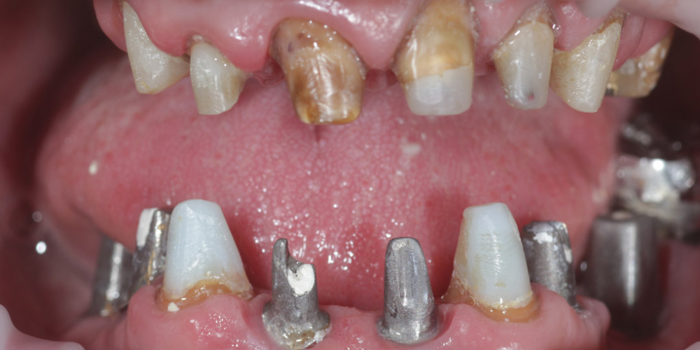 Полная эстетико-функциональная реабилитация зубов - фото №2
