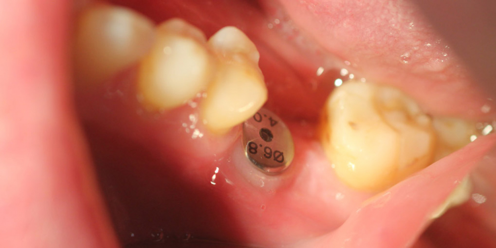 Удаление зуба с одномоментной установкой имплантата DENTIUM + протезирование - фото №1