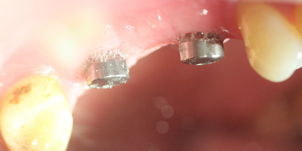 Восстановление двух зубов подряд: имплантация, синус-лифтинг, протезирование - фото №1