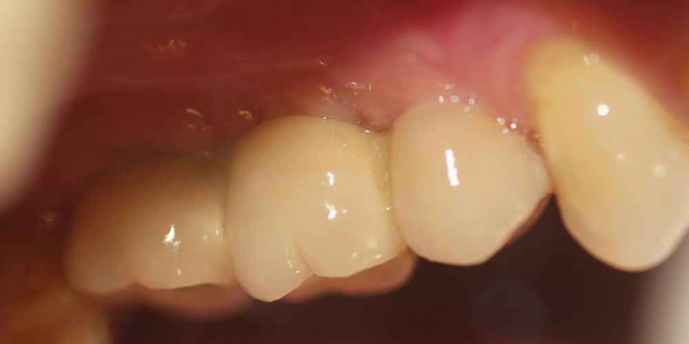 Восстановление двух зубов подряд: имплантация, синус-лифтинг, протезирование - фото №2