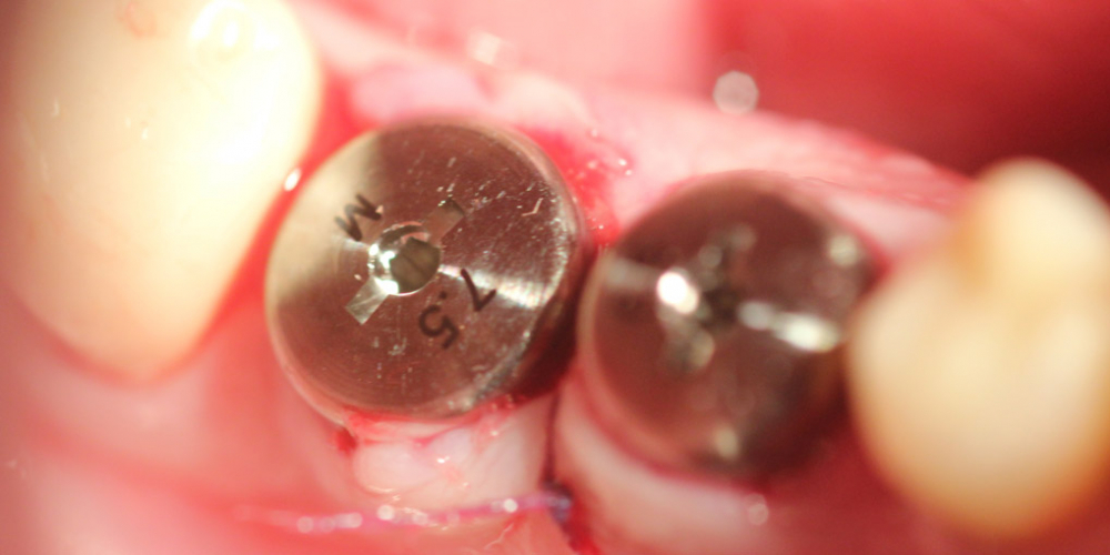 Удаление двух зубов и вживление имплантатов одномоментно - фото №2