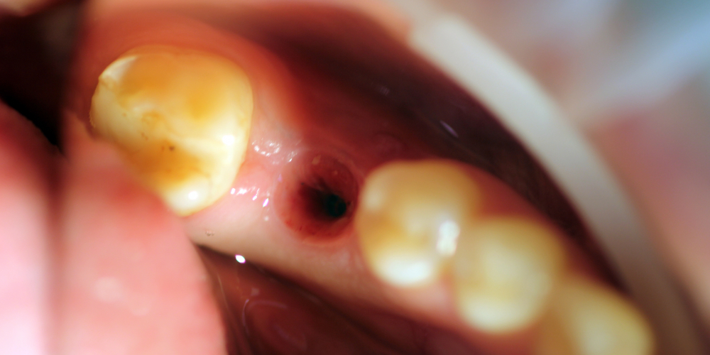 Восстановление отсутствующего зуба с помощью имплантата Ankylos и металлокерамической коронкой - фото №1