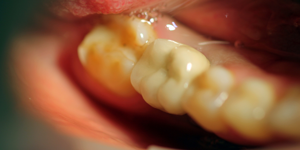Восстановление отсутствующего зуба с помощью имплантата Ankylos и металлокерамической коронкой - фото №2