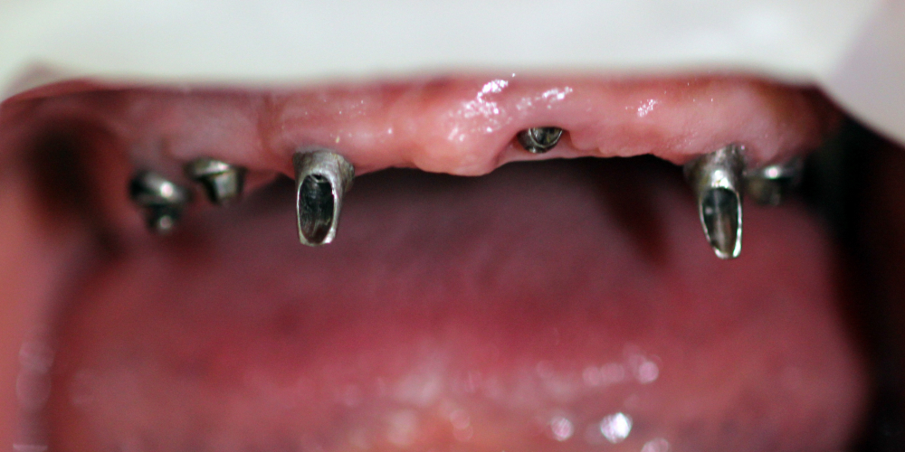 Восстановление жевательной функции при полном отсутствии зубов на верхней и нижней челюсти - фото №1