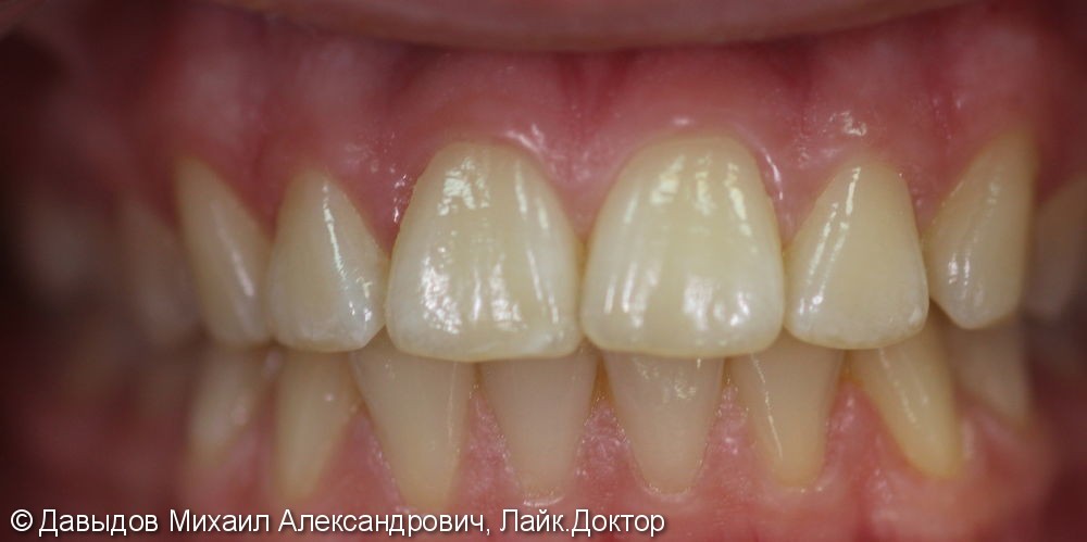 Отбеливание зубов системой BEYOND, до и результат после - фото №1