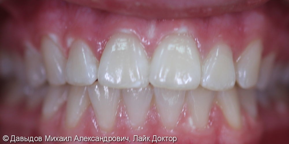 Отбеливание зубов системой BEYOND, до и результат после - фото №4