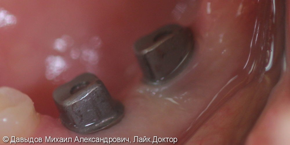 Протезирование на имплантах ANKYLOS с одновременной пластикой десны - фото №3