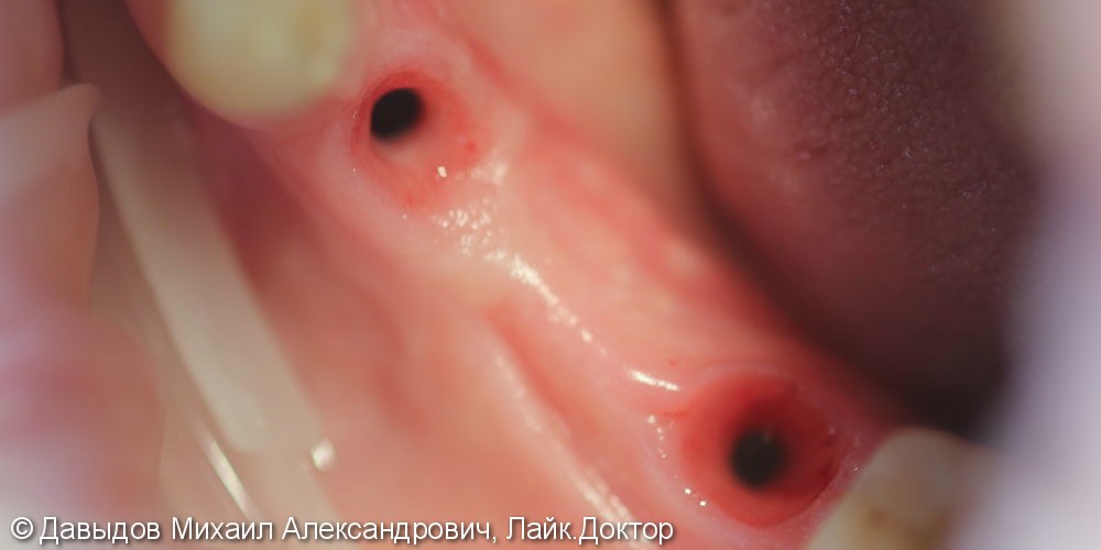 Протезирование трех зубов на двух имплантах, до и после - фото №1