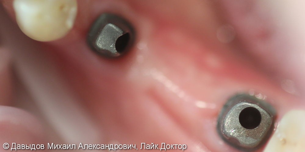 Протезирование трех зубов на двух имплантах, до и после - фото №2