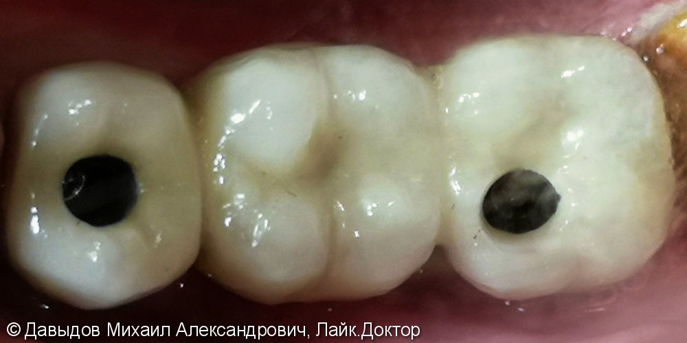 Протезирование зубов с опорой на импланты Mis, до и после - фото №2