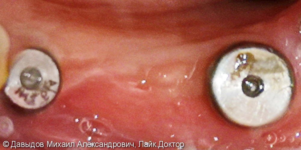 Протезирование зубов с опорой на импланты Mis, до и после - фото №3