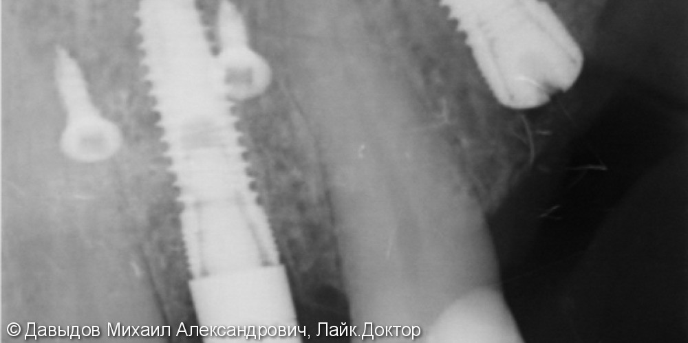 Имплантация с восстановлением дефекта вестибулярной костной стенки - фото №3
