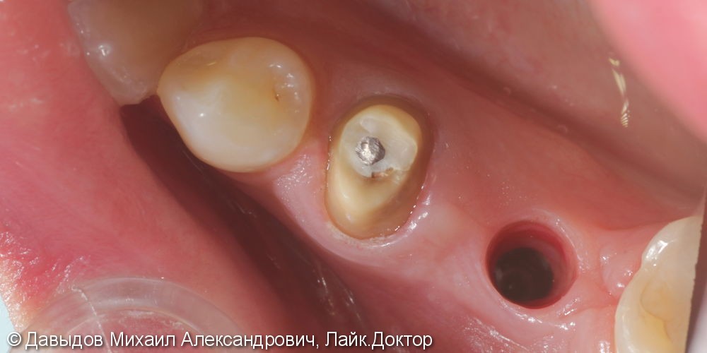 Протезирование двух зубов на импланте ICX-TEMPLANT и на собственном зубе - фото №1