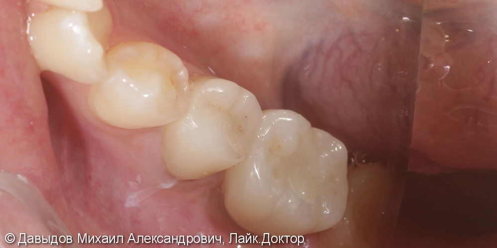 Протезирование двух зубов на импланте ICX-TEMPLANT и на собственном зубе - фото №4