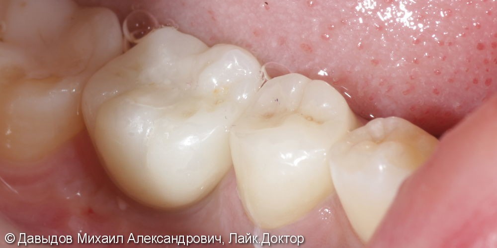 Протезирование двух зубов на импланте ICX-TEMPLANT и на собственном зубе - фото №3