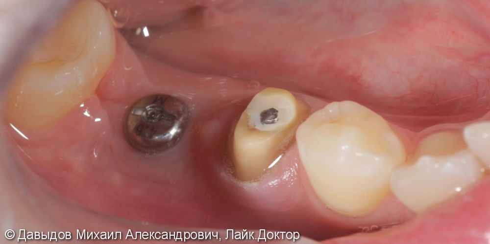 Протезирование двух зубов на импланте ICX-TEMPLANT и на собственном зубе - фото №2