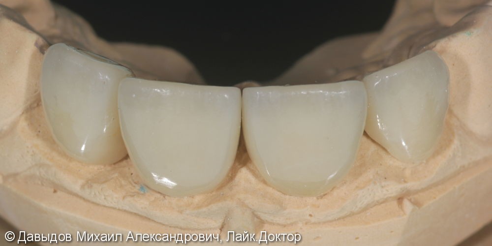 Коронки Е.МАХ на фронтальной группе зубов - фото №2