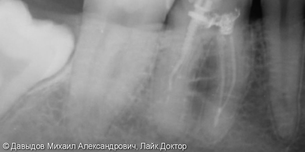 Одномоментная имплантация и протезирование коронкой из диоксида циркония с винтовой фиксацией - фото №1