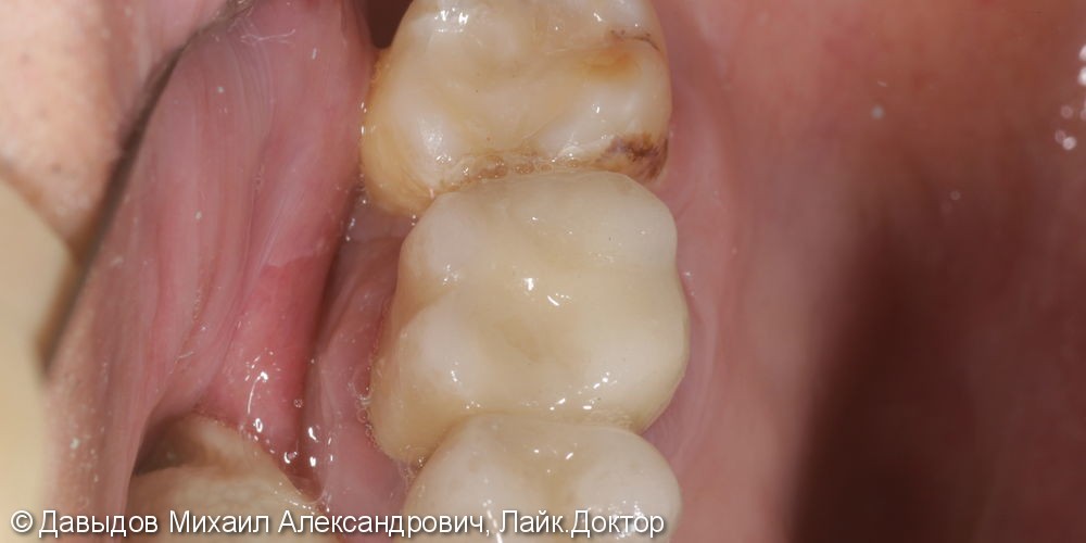 Одномоментная имплантация зуба 46 - фото №1