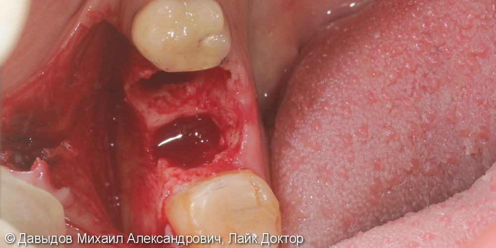 Одномоментная имплантация зуба 46 - фото №2