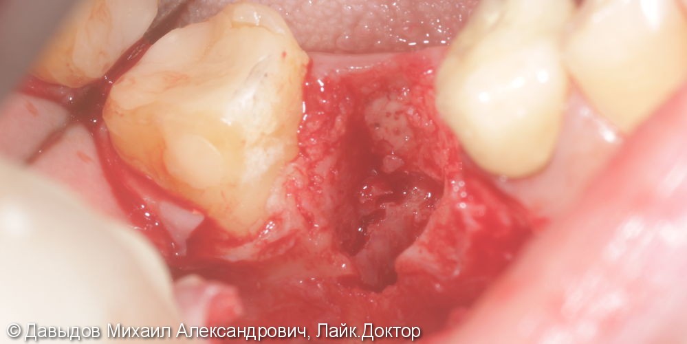 Одномоментная имплантация зуба 46 - фото №3