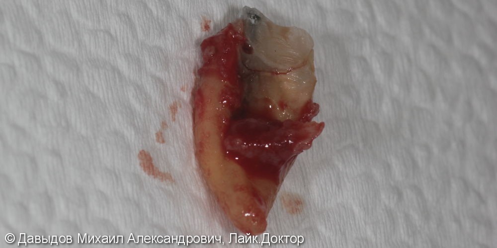 Одномоментная имплантация зуба 46 - фото №4