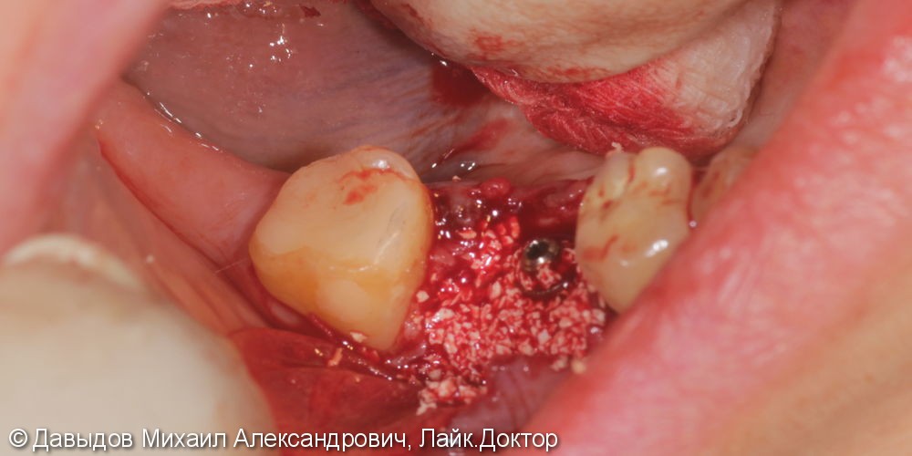 Одномоментная имплантация зуба 46 - фото №6