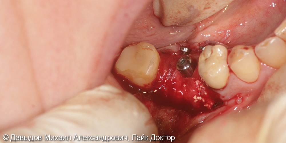 Одномоментная имплантация зуба 46 - фото №8