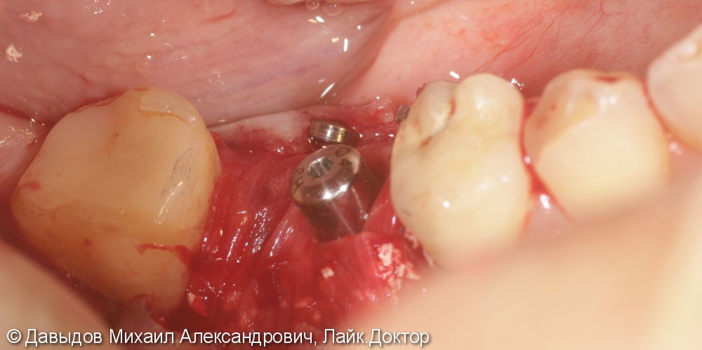 Одномоментная имплантация зуба 46 - фото №9