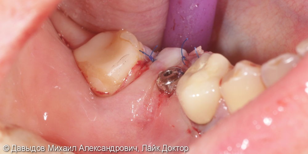 Одномоментная имплантация зуба 46 - фото №10