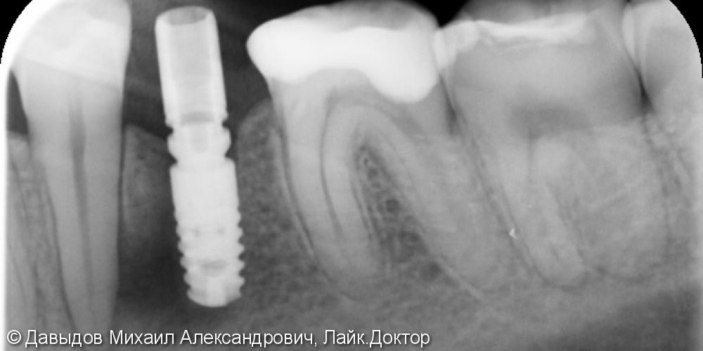 Имплантация зуба 36 - фото №2