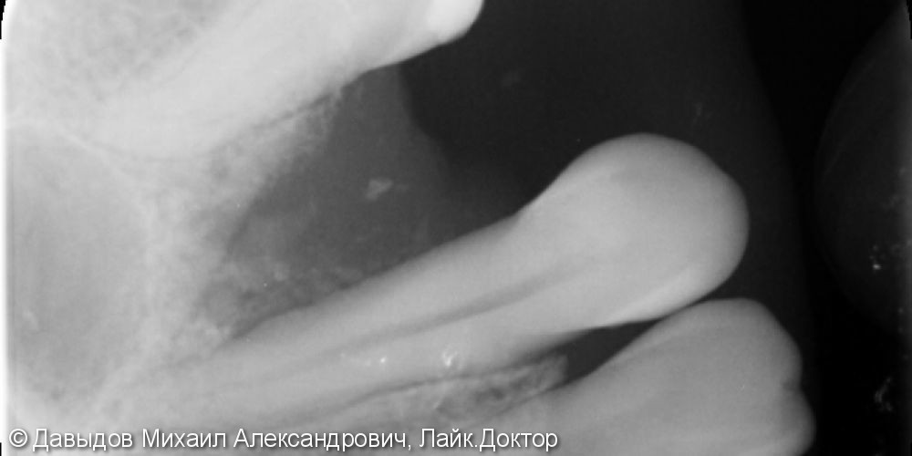 Операция имплантации зуба 24 - фото №1